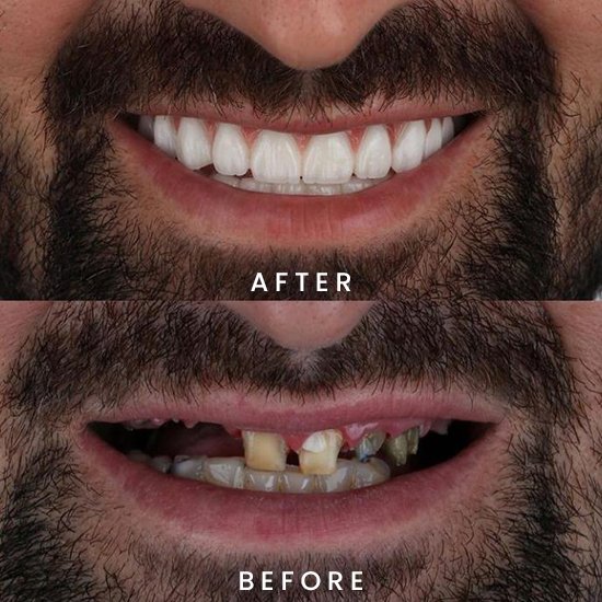 making-of-aesthetic-teeth-for-full-mouth-reconstruction